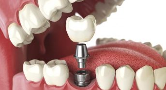 Trồng răng implant có tốt không?